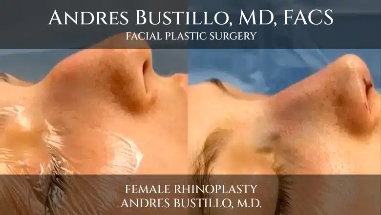 Cirugía de rinoplastia en una paciente femenina realizada por Andres Bustillo, M.D.