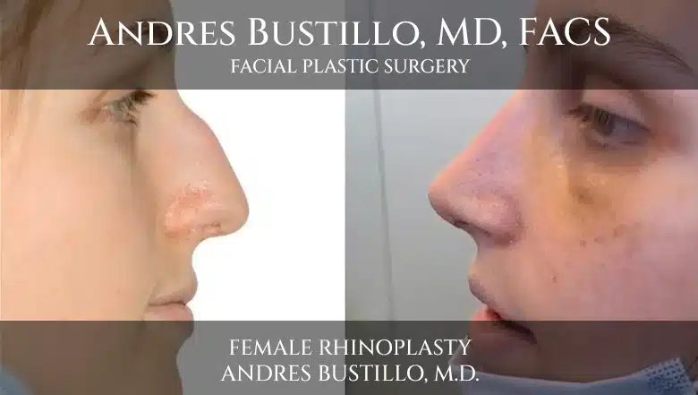 Cirugía de rinoplastia en una paciente femenina realizada por Andres Bustillo, M.D.