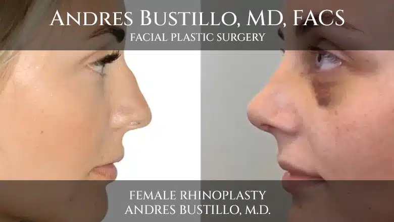 Cirugía de rinoplastia en una paciente femenina realizada por Andres Bustillo, M.D.