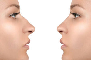 Comparación de perfil de antes y después del rostro de una mujer, mostrando la corrección de una giba dorsal para lograr un puente nasal liso y recto.
