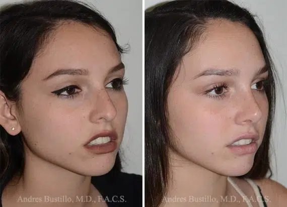 Rinoplastía (Cirugía de nariz) fFotos de Antes y Después en Miami, FL, Paciente 14235