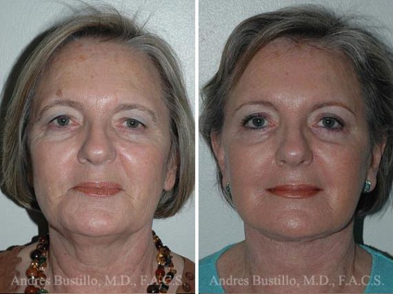 Lifting facial (facelift) fFotos de Antes y Después en Miami, FL, Paciente 9572