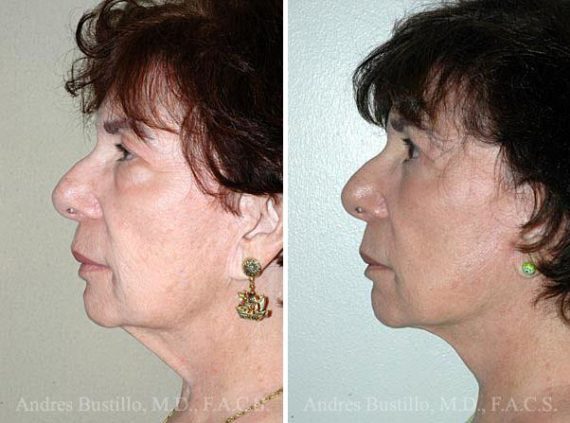 Lifting facial (facelift) fFotos de Antes y Después en Miami, FL, Paciente 9586