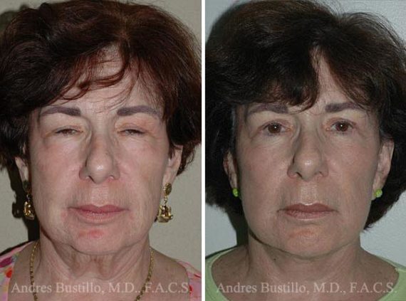 Lifting facial (facelift) fFotos de Antes y Después en Miami, FL, Paciente 9586