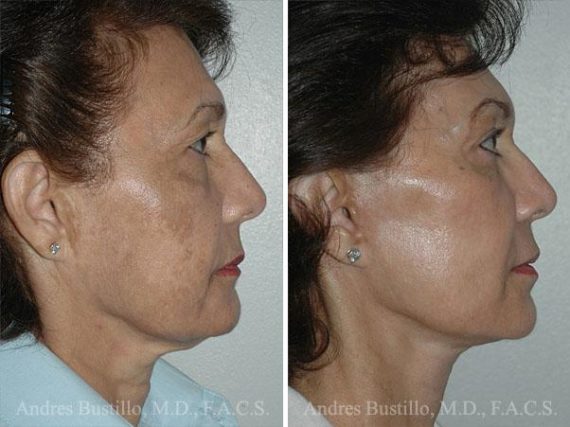 Lifting facial (facelift) fFotos de Antes y Después en Miami, FL, Paciente 9600