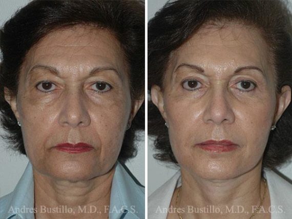 Lifting facial (facelift) fFotos de Antes y Después en Miami, FL, Paciente 9600