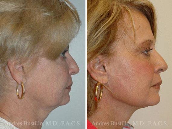 Lifting facial (facelift) fFotos de Antes y Después en Miami, FL, Paciente 9607