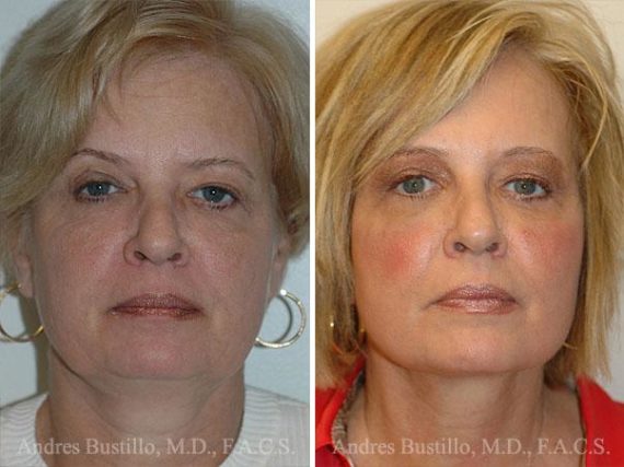 Lifting facial (facelift) fFotos de Antes y Después en Miami, FL, Paciente 9607