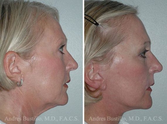 Lifting facial (facelift) fFotos de Antes y Después en Miami, FL, Paciente 9614