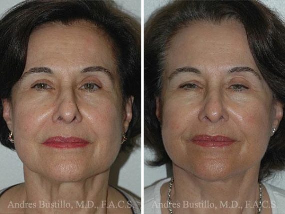 Lifting facial (facelift) fFotos de Antes y Después en Miami, FL, Paciente 9628