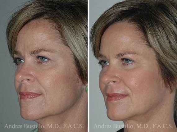 Lifting de cuello fFotos de Antes y Después en Miami, FL, Paciente 9649