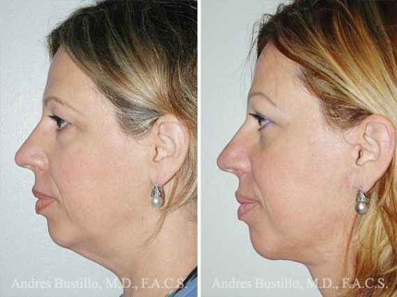 Lifting facial (facelift) fFotos de Antes y Después en Miami, FL, Patient 9593