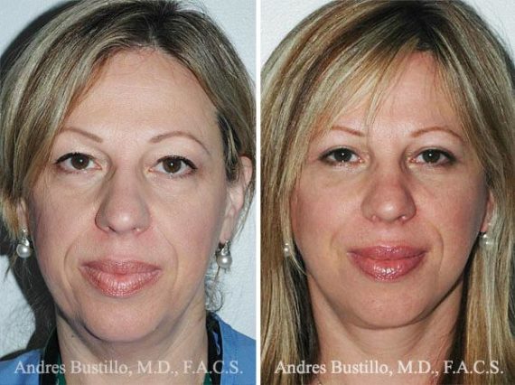 Lifting facial (facelift) fFotos de Antes y Después en Miami, FL, Patient 9593