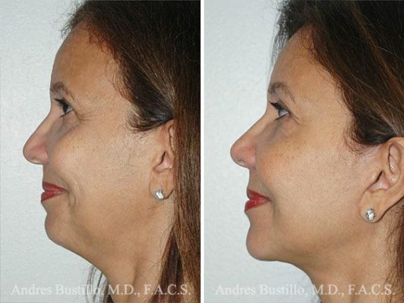 Lifting facial (facelift) fFotos de Antes y Después en Miami, FL, Patient 9621