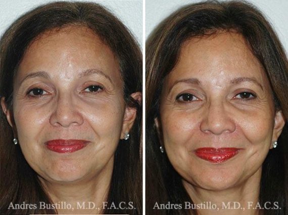 Lifting facial (facelift) fFotos de Antes y Después en Miami, FL, Patient 9621