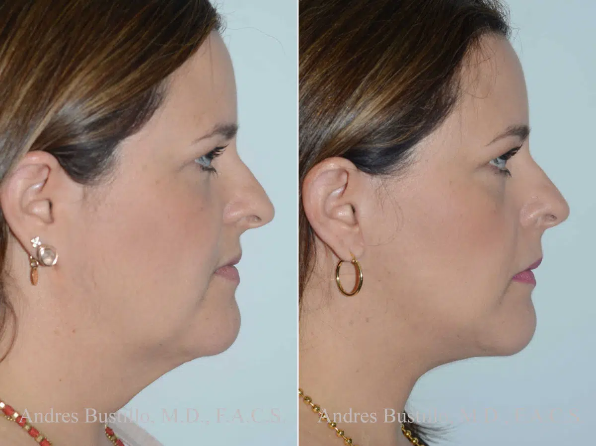 Lifting facial (facelift) fFotos de Antes y Después en Miami, FL, Paciente 14391