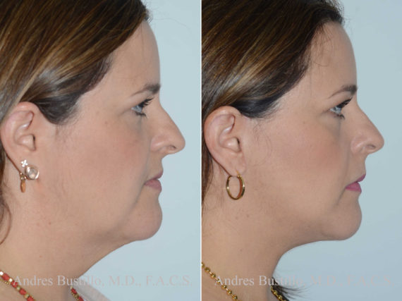 Lifting facial (facelift) fFotos de Antes y Después en Miami, FL, Paciente 14391