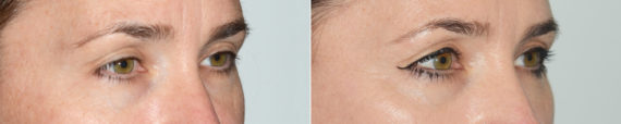 Blefaroplastia (párpados) fFotos de Antes y Después en Miami, FL, Paciente 15605
