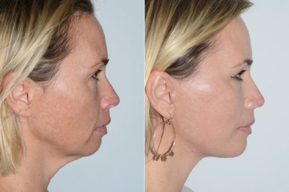 Lifting facial (facelift) fFotos de Antes y Después en Miami, FL, Paciente 15604