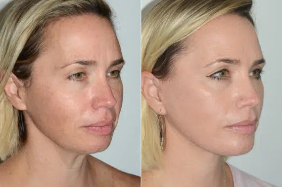 Lifting de Plano Profundo fFotos de Antes y Después en Miami, FL, Paciente 15604