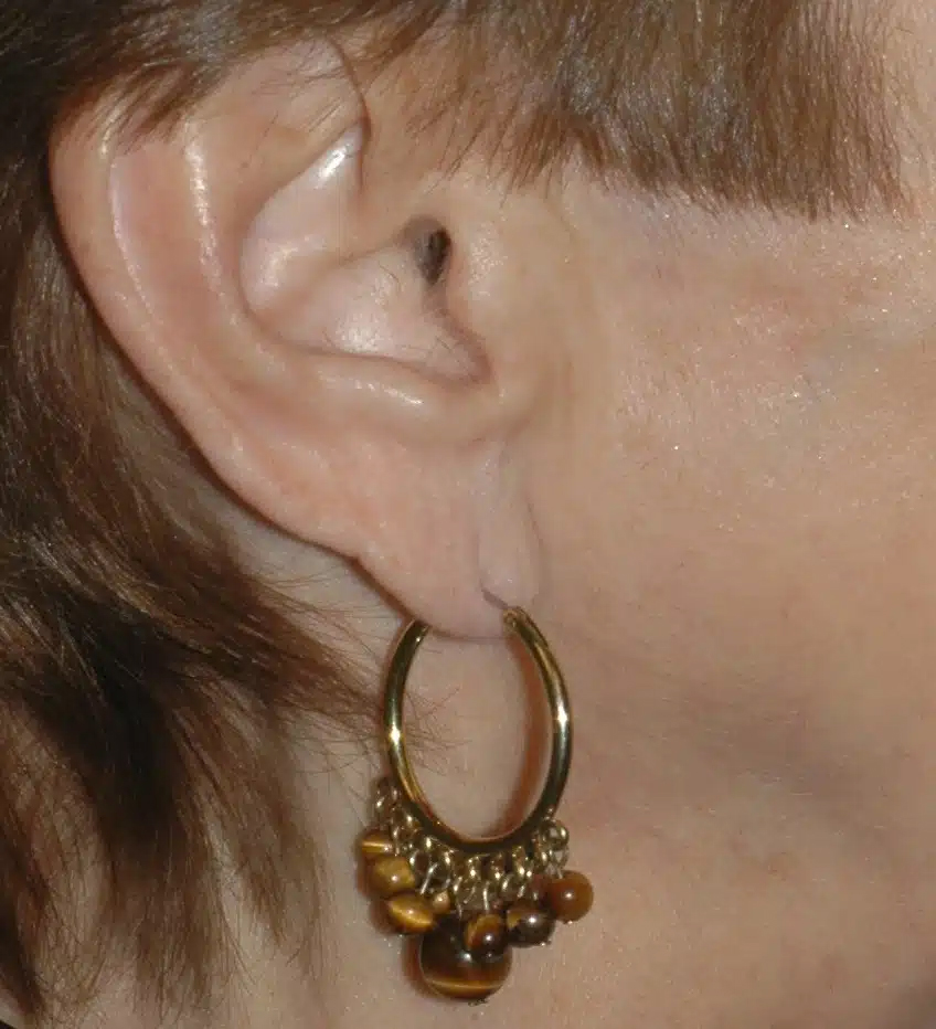 Figura 6.
Oreja de la paciente antes de someterse a una cirugía de lifting facial con el Dr. Bustillo.