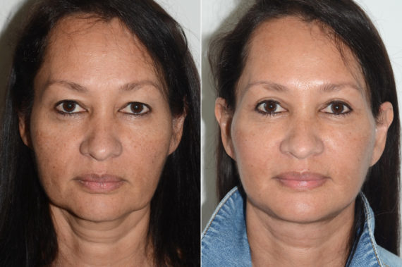 Lifting facial (facelift) fFotos de Antes y Después en Miami, FL, Paciente 16447