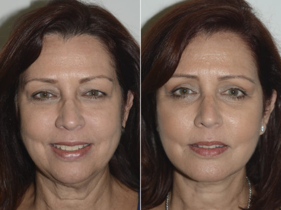 Lifting facial (facelift) fFotos de Antes y Después en Miami, FL, Paciente 16457