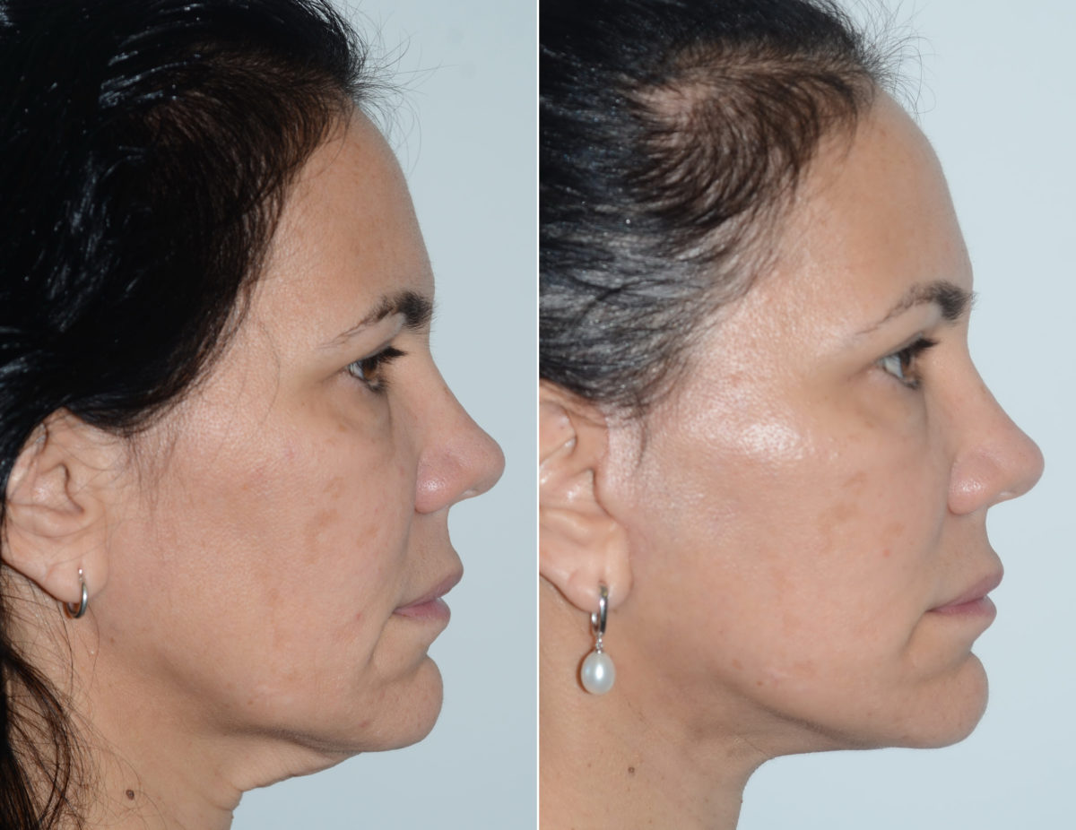 Lifting facial (facelift) fFotos de Antes y Después en Miami, FL, Paciente 16467