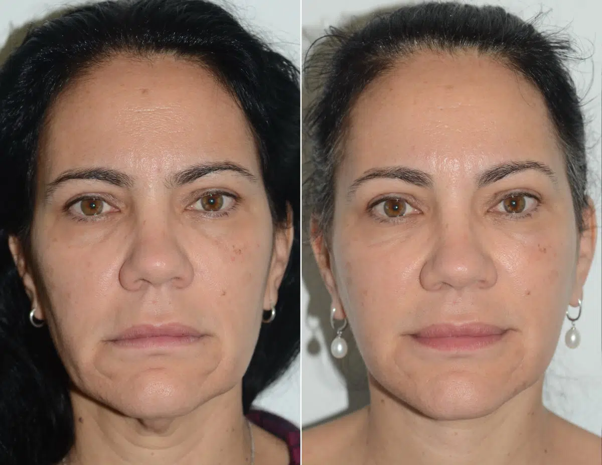 Lifting facial (facelift) fFotos de Antes y Después en Miami, FL, Paciente 16467