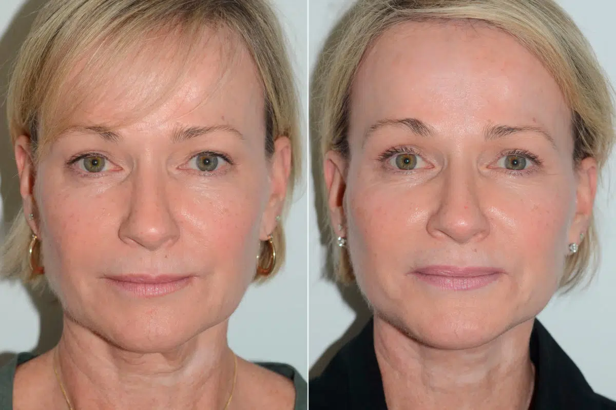 Lifting facial (facelift) fFotos de Antes y Después en Miami, FL, Paciente 16487