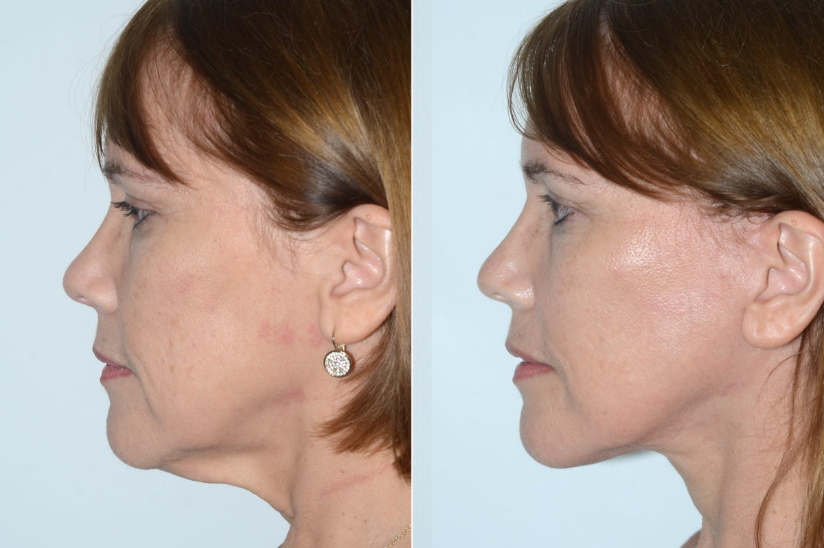 Lifting facial (facelift) fFotos de Antes y Después en Miami, FL, Paciente 16508