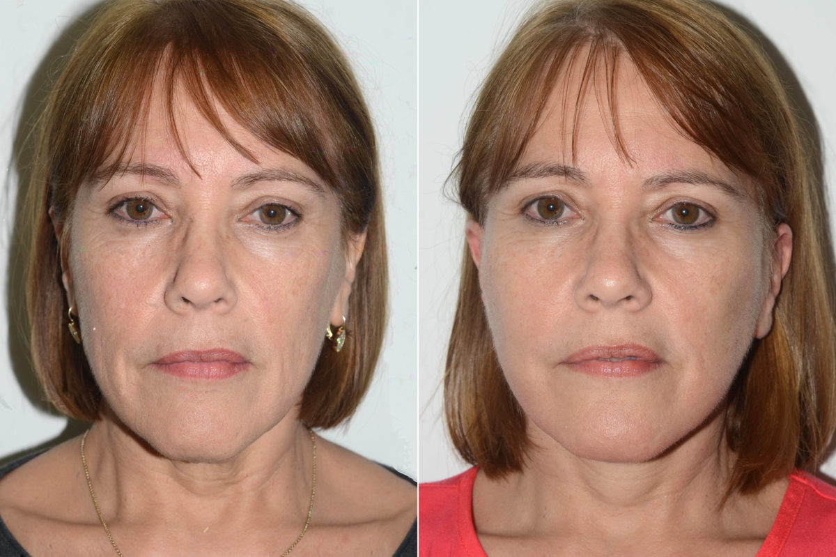 Lifting facial (facelift) fFotos de Antes y Después en Miami, FL, Paciente 16508