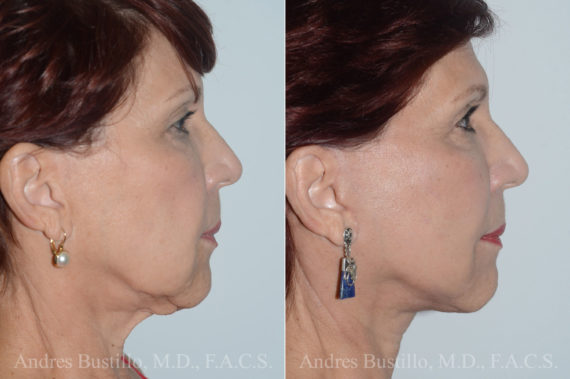 Lifting facial (facelift) fFotos de Antes y Después en Miami, FL, Paciente 16519