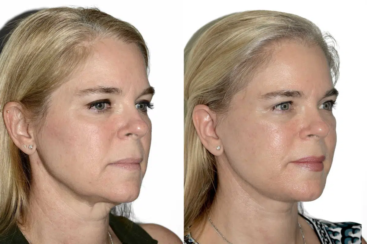 Lifting facial (facelift) fFotos de Antes y Después en Miami, FL, Paciente 16805