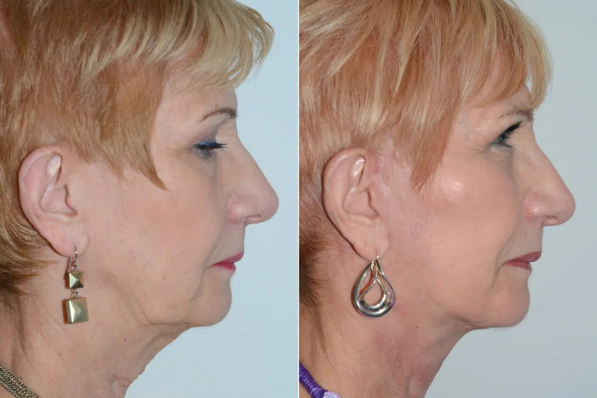 Lifting facial (facelift) fFotos de Antes y Después en Miami, FL, Paciente 15018