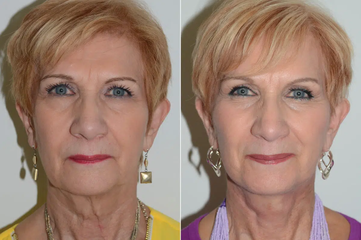 Lifting facial (facelift) fFotos de Antes y Después en Miami, FL, Paciente 15018