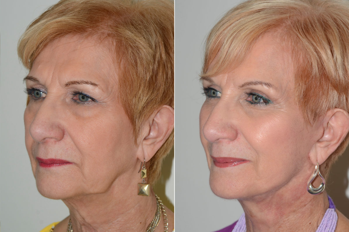 Lifting facial (facelift) fFotos de Antes y Después en Miami, FL, Paciente 15018