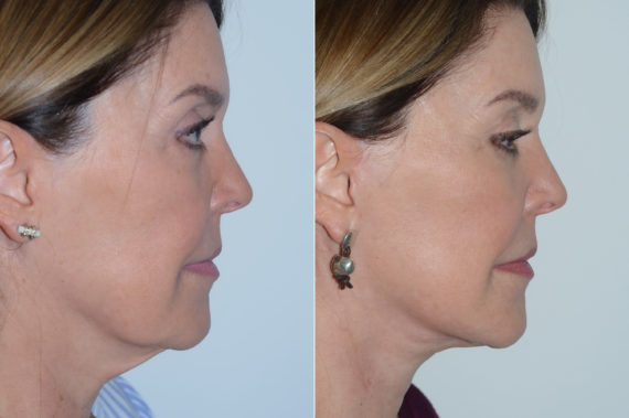 Lifting facial (facelift) fFotos de Antes y Después en Miami, FL, Paciente 16529