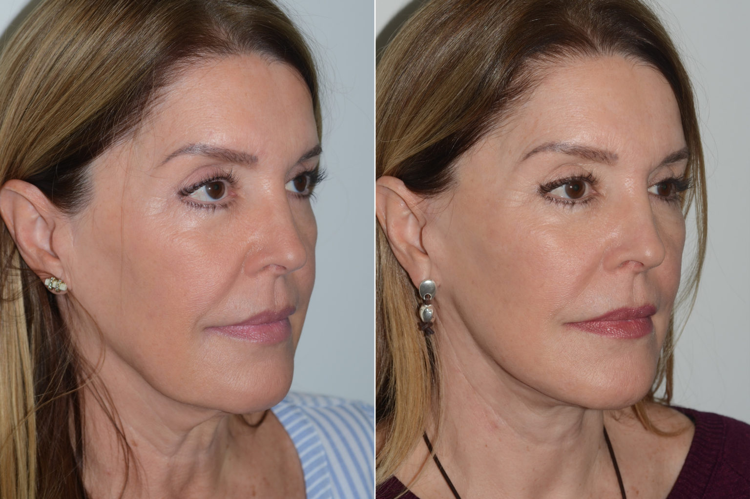 Lifting facial (facelift) fotos Coral Gables, FL Paciente 16529