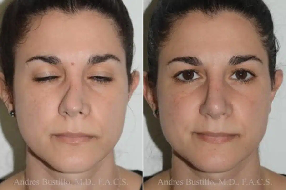 Hay muchos tipos diferentes de rinoplastias, incluidas la cirugía abierta, la cirugía cerrada, la cirugía endoscópica y los procedimientos mínimamente invasivos, que influyen en el costo de la rinoplastia