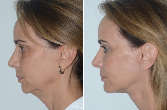 Lifting de Plano Profundo fFotos de Antes y Después en Miami, FL, Paciente 17506