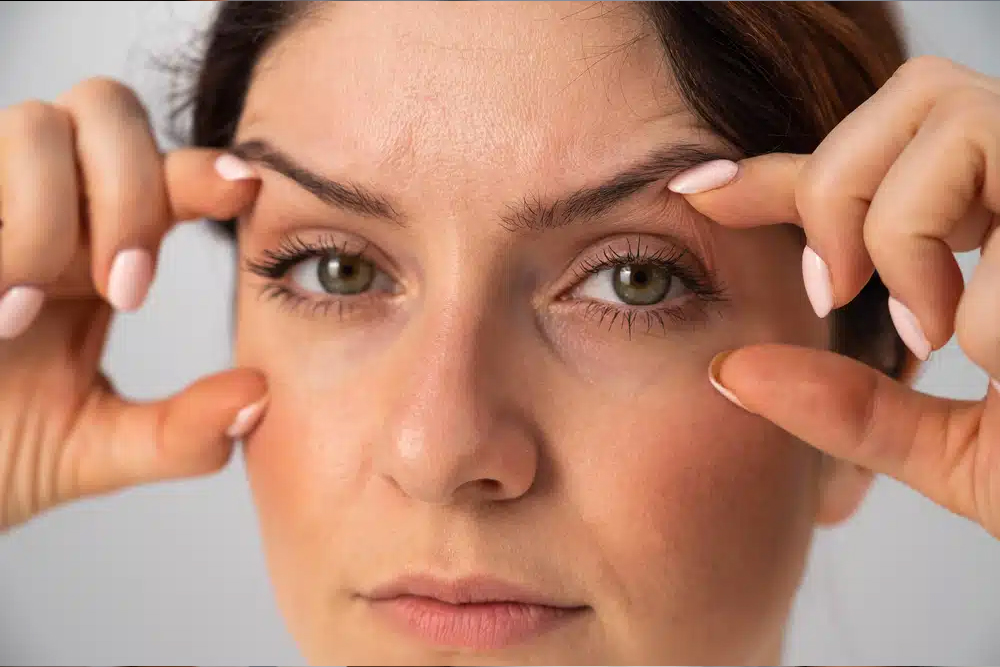 La cicatriz de blefaroplastia inicialmente se verá roja y puede estar ligeramente elevada.