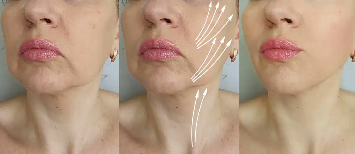 Costo promedio del lifting facial en el sur de Florida.