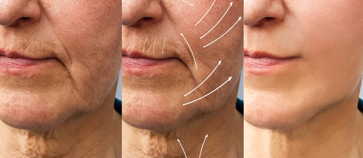 Costo promedio del lifting facial y del lifting de plano profundo en Florida