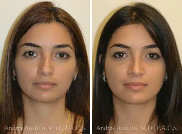 El Dr. Bustillo personaliza la rinoplastia étnica, honrando rasgos diversos para resultados personalizados que preservan la identidad cultural.