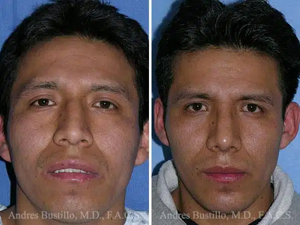 La rinoplastia étnica preserva los rasgos individuales mientras refina la estética nasal, honrando la identidad cultural mediante procedimientos personalizados y especializados.