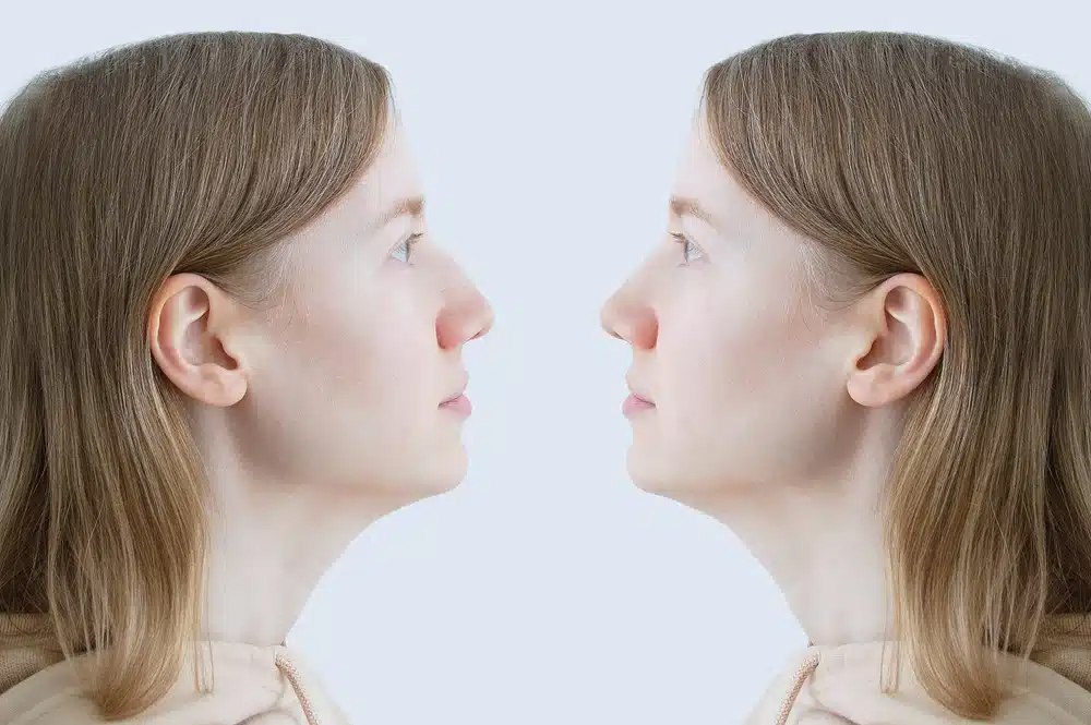 Vista comparativa del perfil de una mujer antes y después de una rinoplastia para nariz aguileña, destacando posibles cambios.