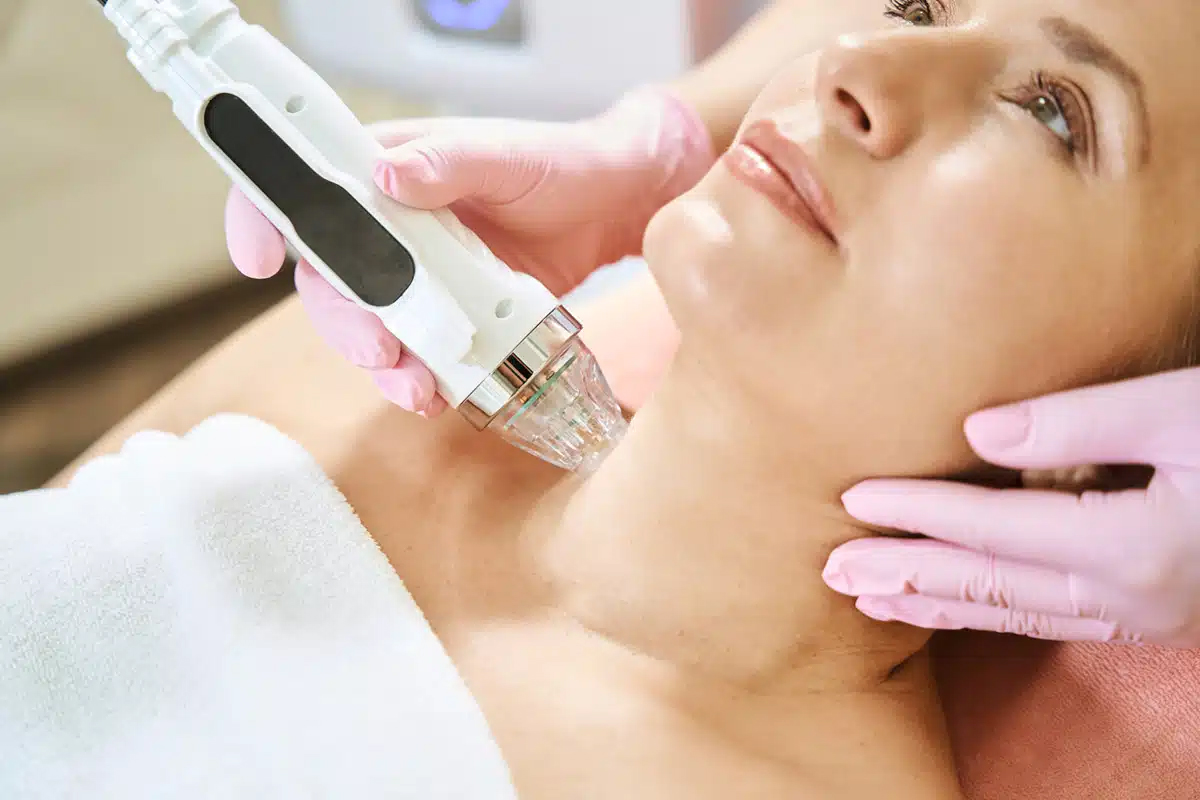 Primer plano de tratamiento de microneedling con RF en el cuello de una paciente para tensar la piel.