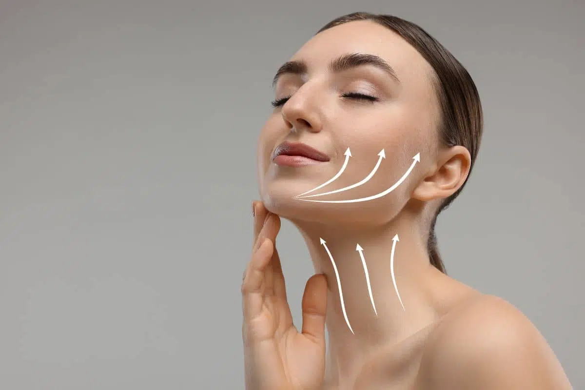 Mujer con flechas en el rostro y el cuello que muestran los vectores de elevación de las técnicas de lifting de plano profundo y lifting SMAS.