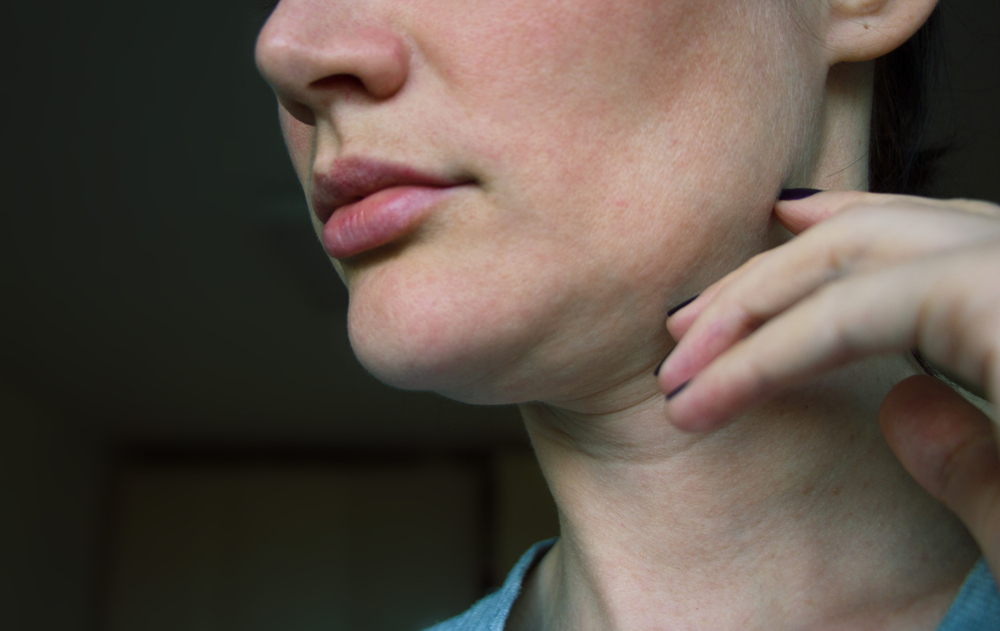 Primer plano de la parte inferior del rostro de una mujer que muestra flacidez mandibular temprana y laxitud de la piel debido al envejecimiento y al debilitamiento de los ligamentos